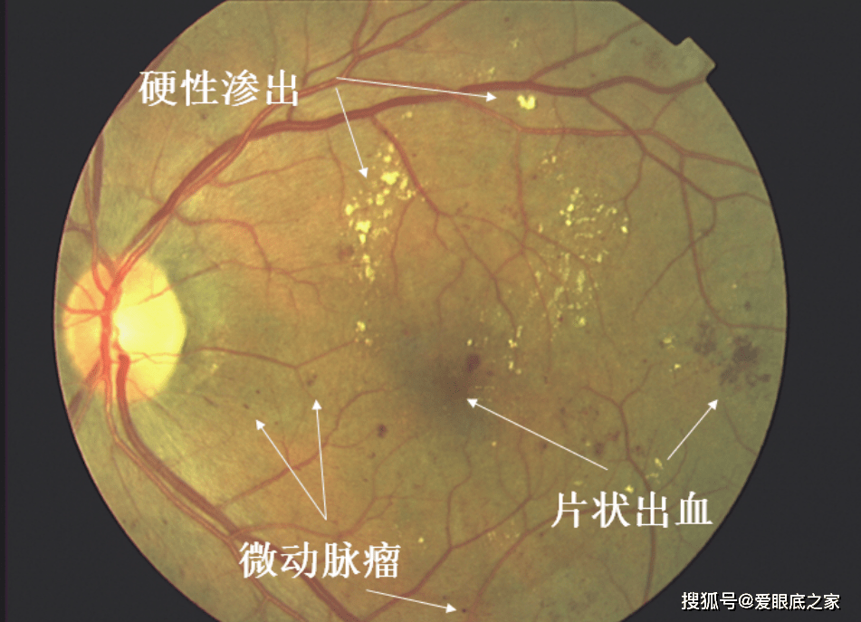 最新视网膜技术，重塑视觉世界的希望之光